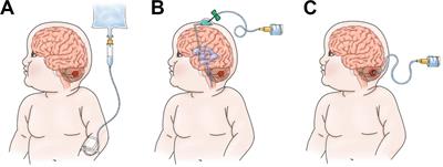 CAR T Cell Therapy for Pediatric Brain Tumors